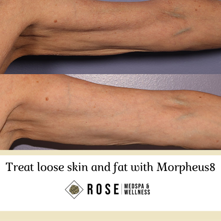 Morpheus8 RF Microneedling (Body)