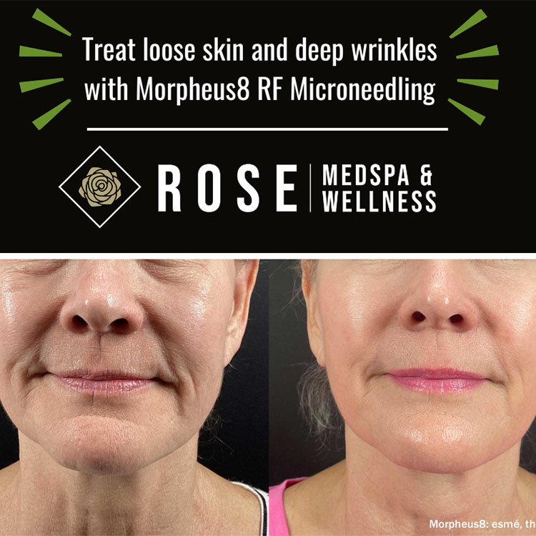 Morpheus8 RF Microneedling (Face)