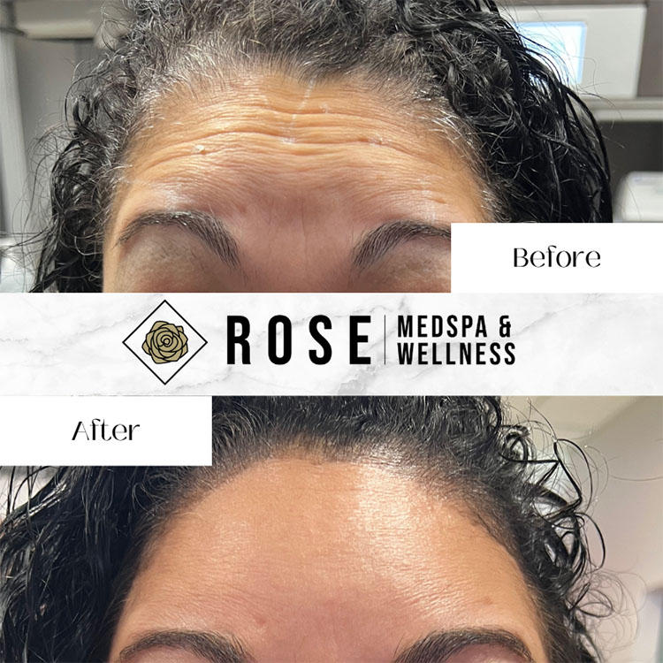 Wrinkle Relaxer Botox