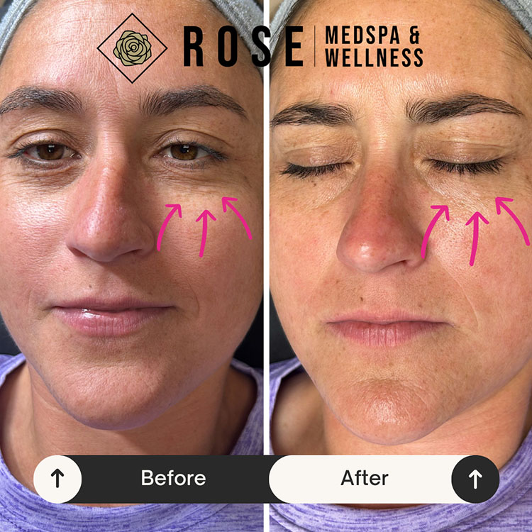 Zemits Hydrafacial